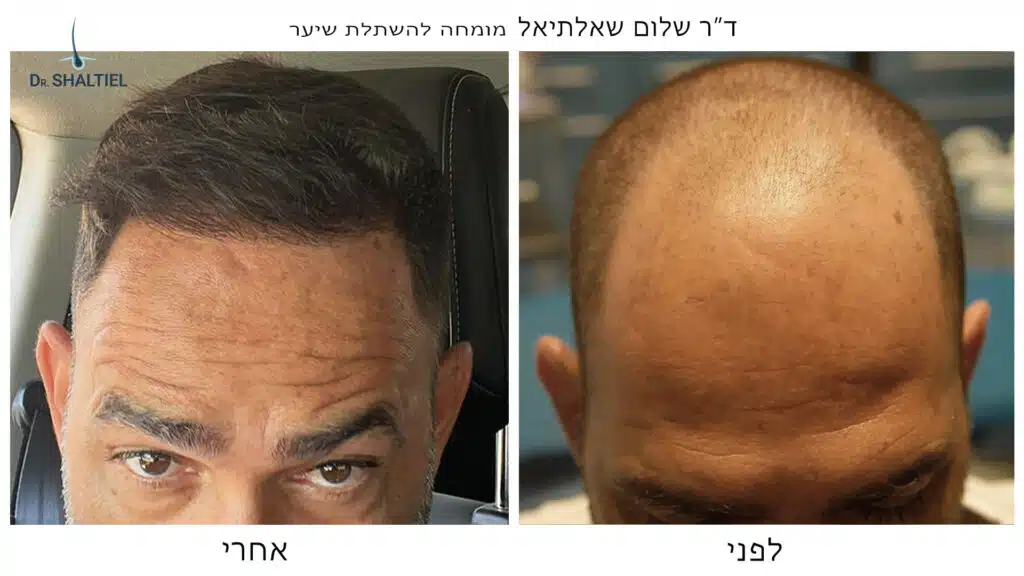 השתלת שיער ד"ר שלום שאלתיאל